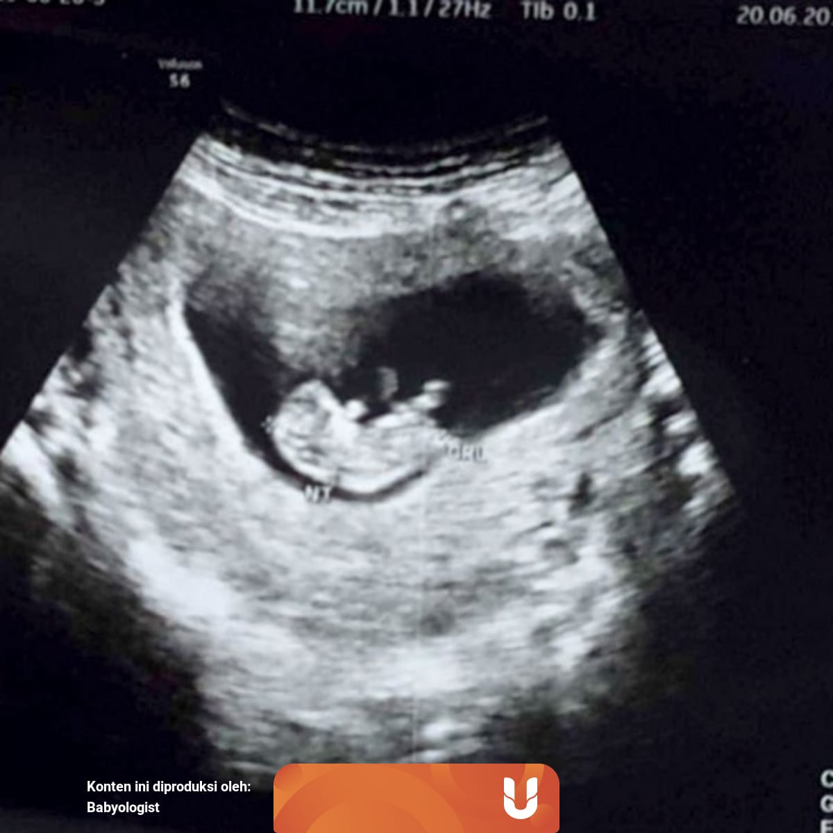 Gambar Hasil Usg Janin Perempuan : Cara Memilih Jenis Kelamin Bayi